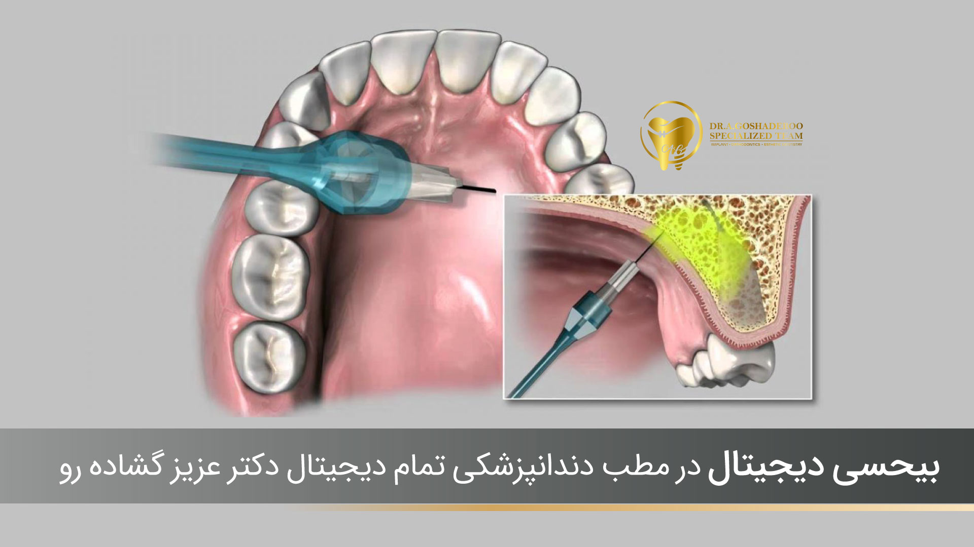 بیحسی دیجیتال چیست ؟مطب دندانپزشکی دکتر عزیز گشاده رو