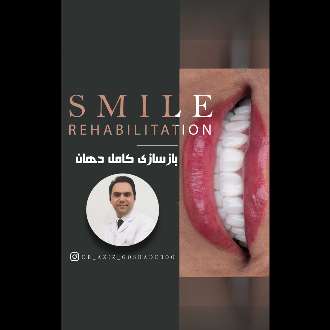 بازسازی کامل دهان با روکش و لمینیتهای سرامیکی