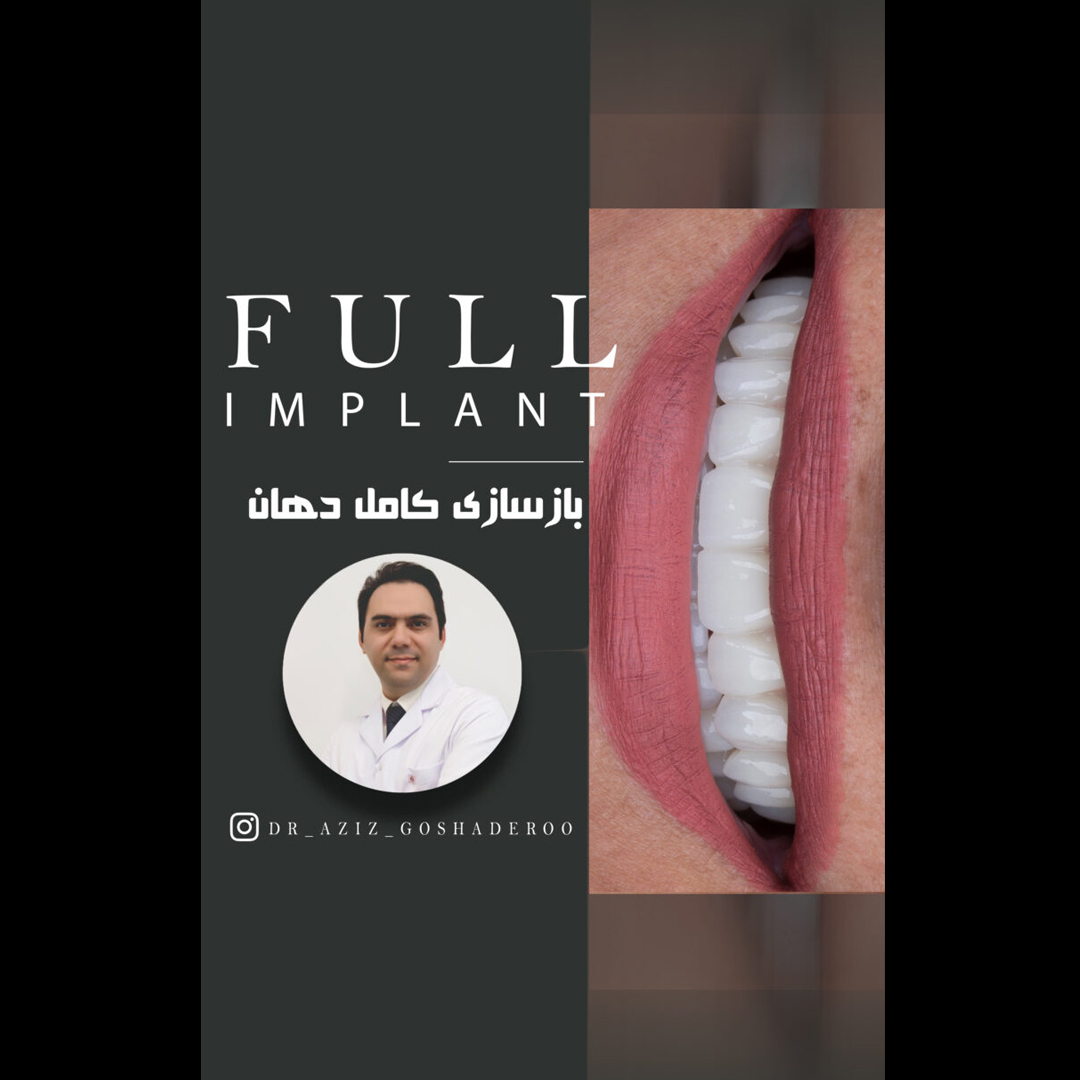 بازسازی کامل دهان با ایمپلنت و روکش زیرکونیا